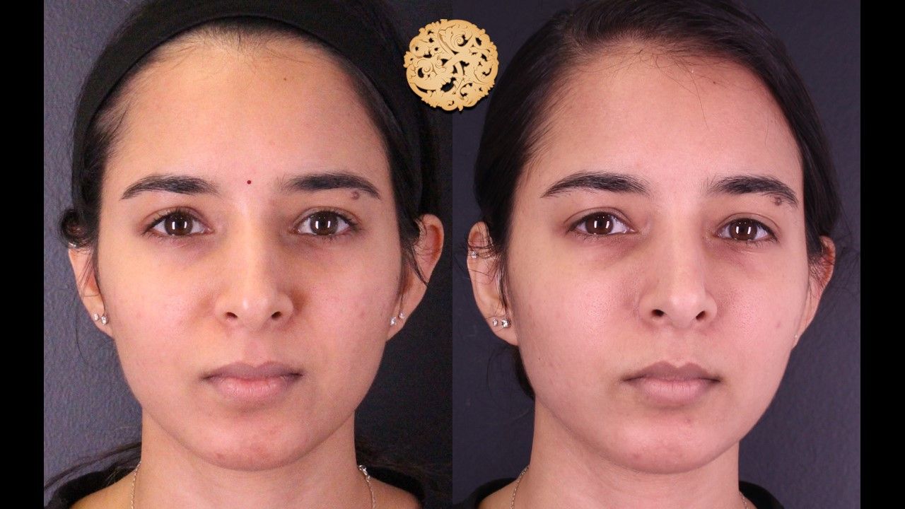 Chemical Peel Before & After