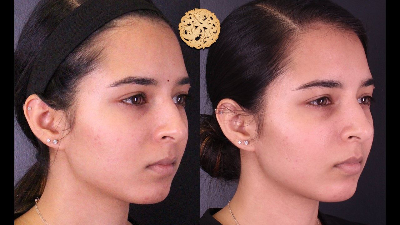 Chemical Peel Before & After