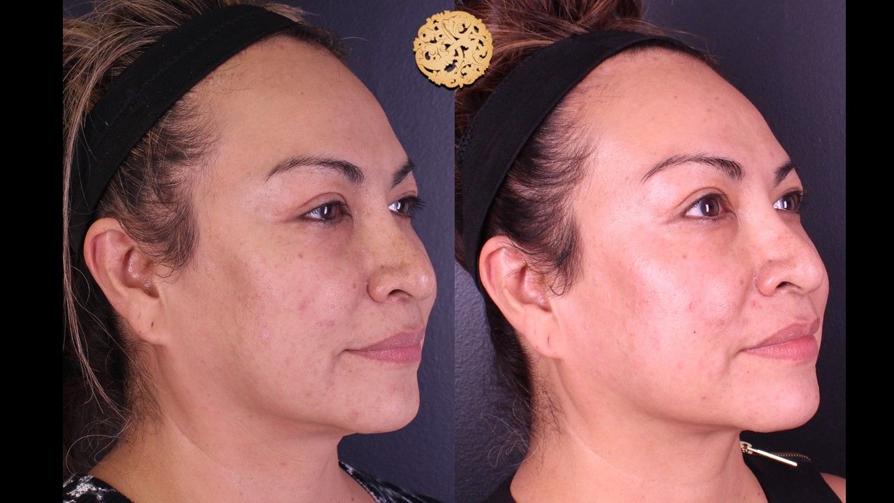 Chemical Peel Before & After