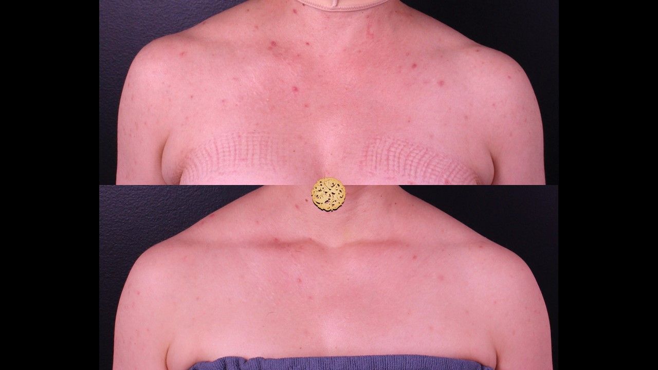 Chemical Peel Before & After