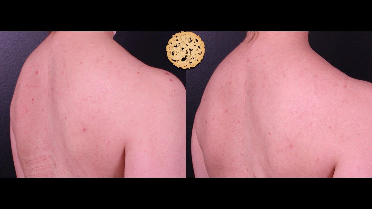 Chemical Peel Before & After