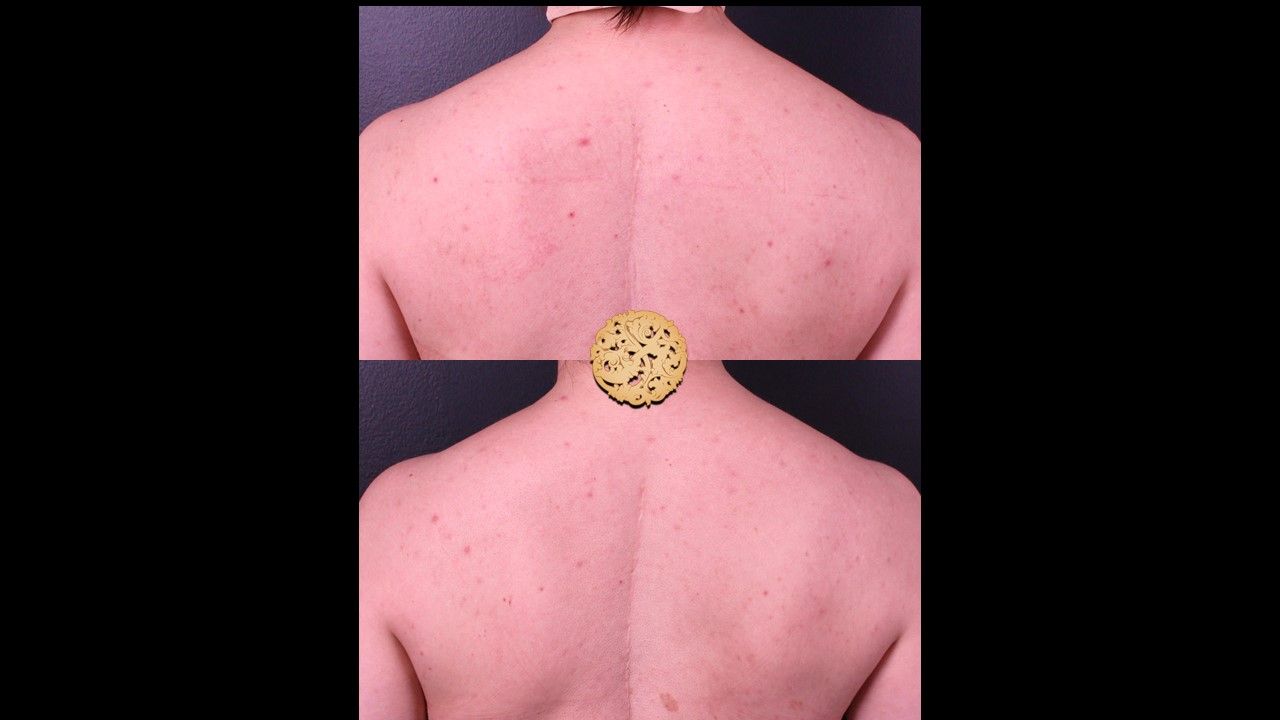 Chemical Peel Before & After