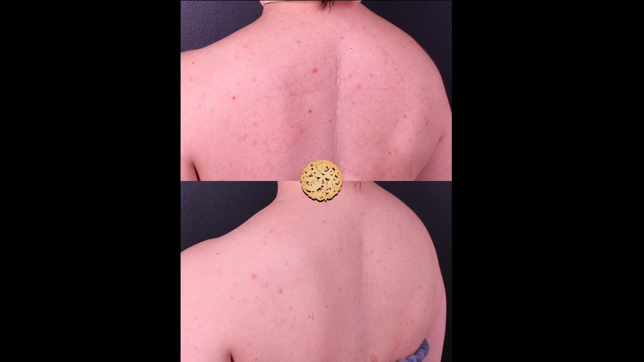 Chemical Peel Before & After