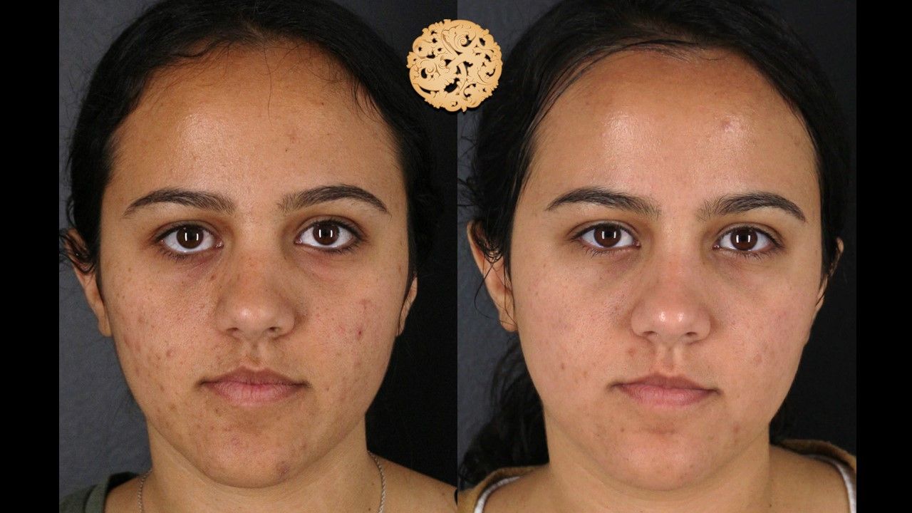 Chemical Peel Before & After