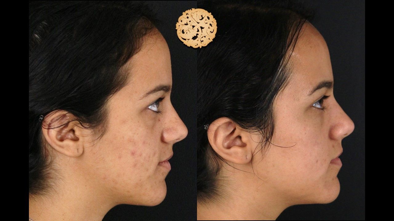 Chemical Peel Before & After
