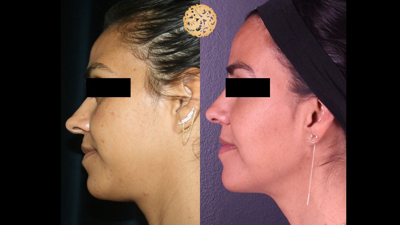 Chemical Peel Before & After