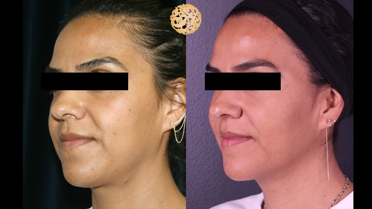 Chemical Peel Before & After