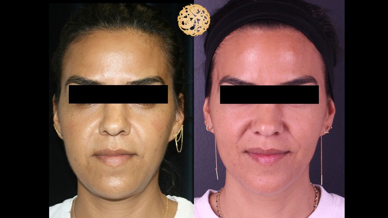 Chemical Peel Before & After