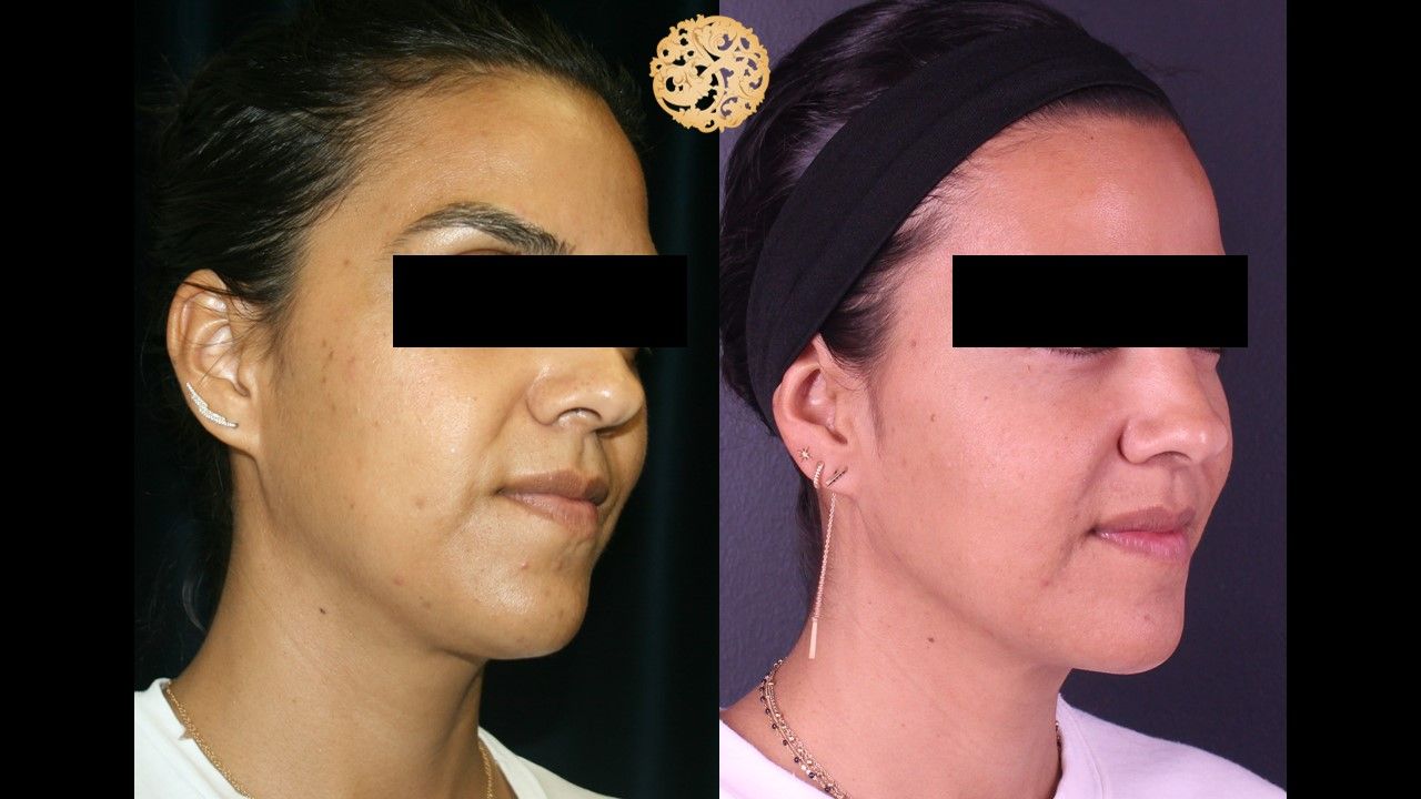 Chemical Peel Before & After