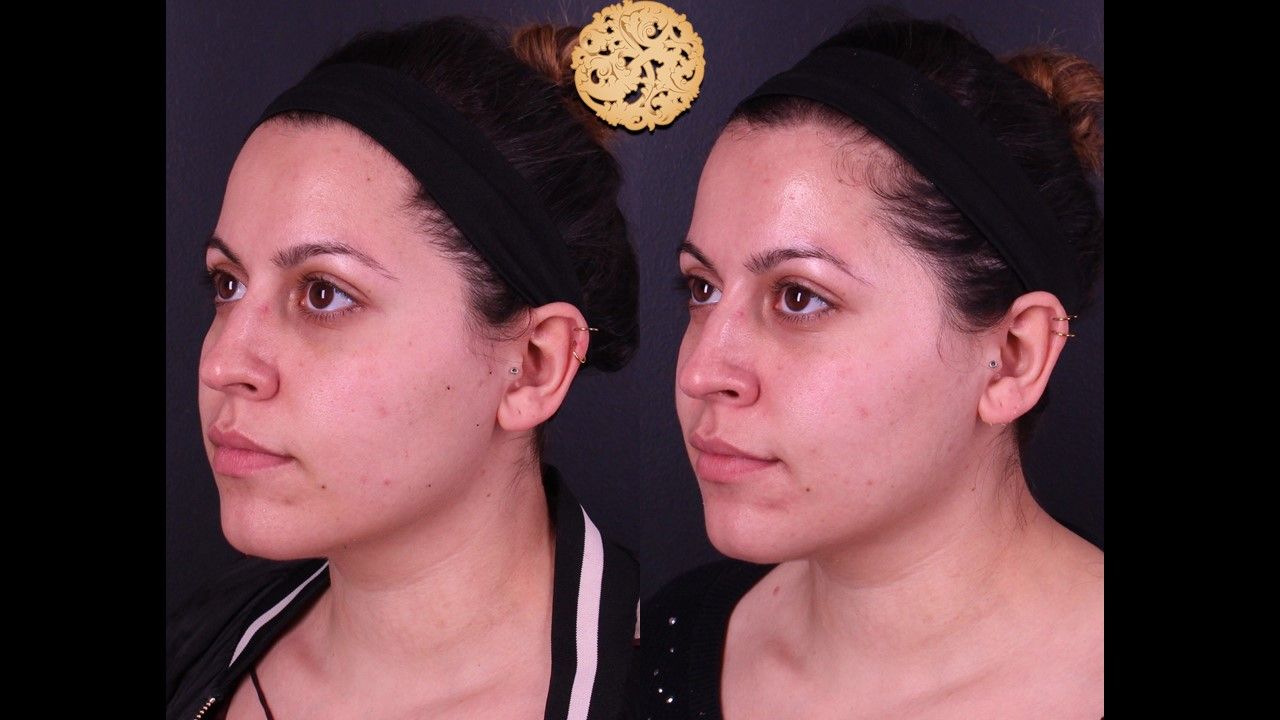 Chemical Peel Before & After
