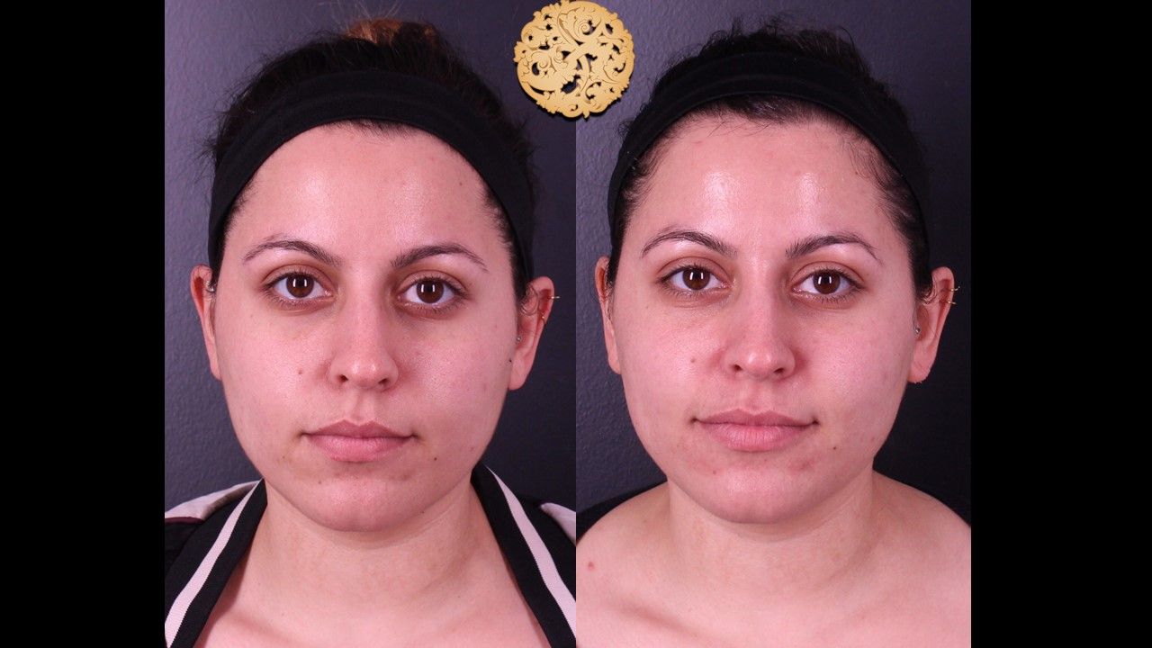 Chemical Peel Before & After