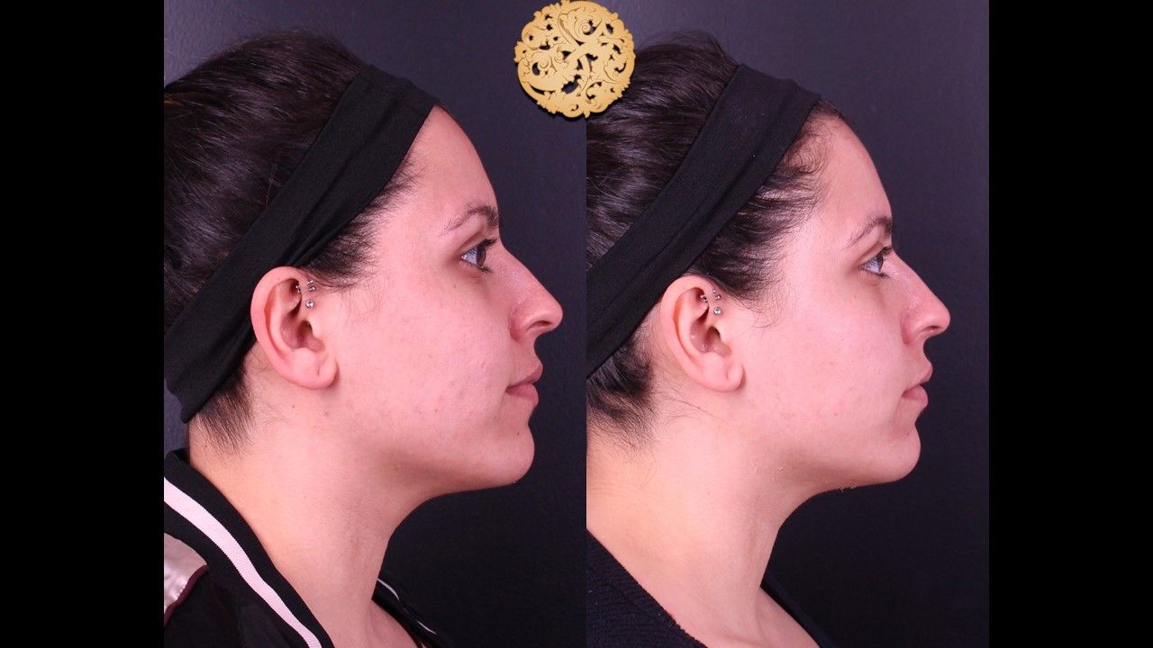 Chemical Peel Before & After