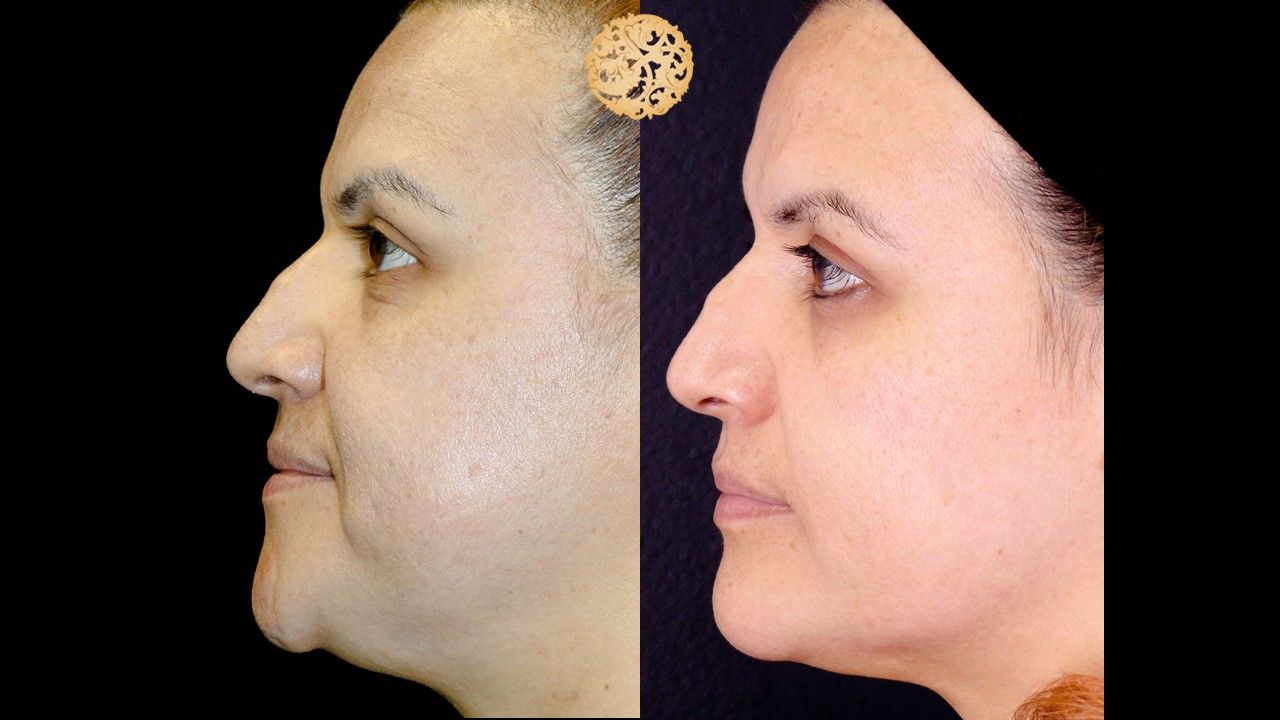 Chemical Peel Before & After