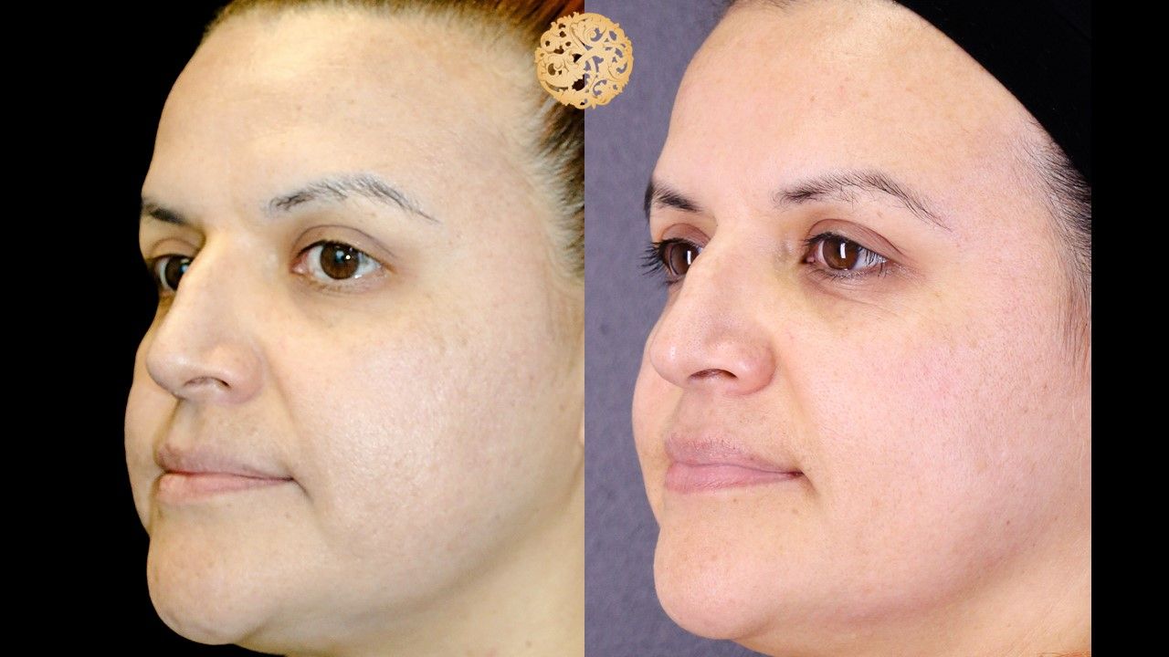 Chemical Peel Before & After
