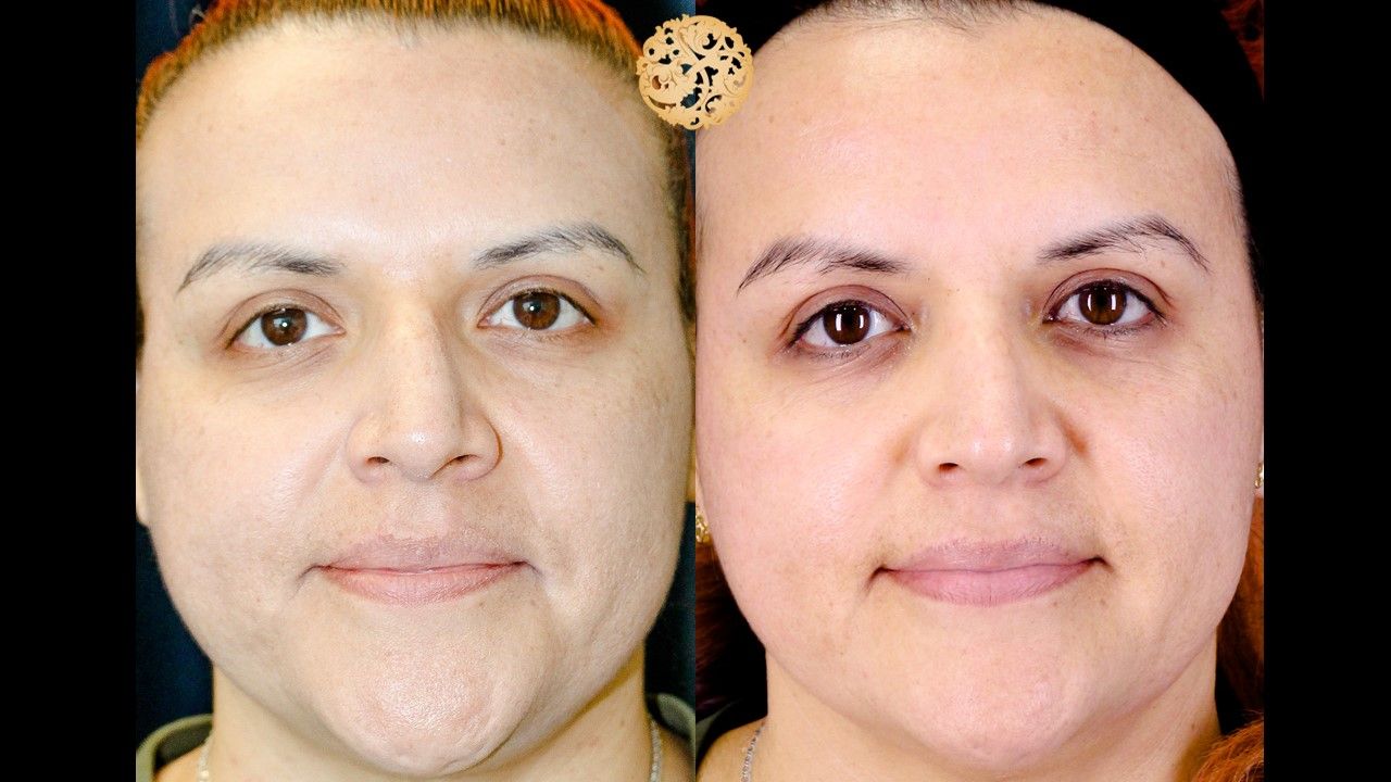 Chemical Peel Before & After