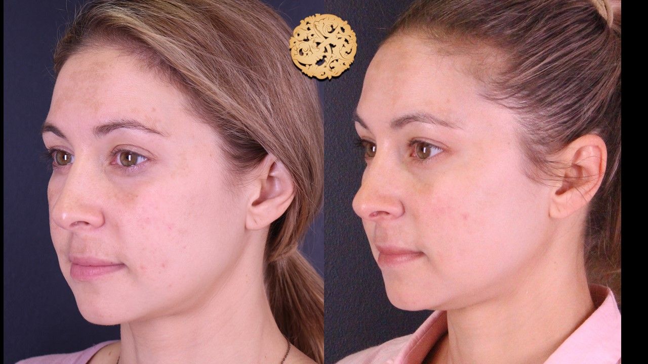 Chemical Peel Before & After