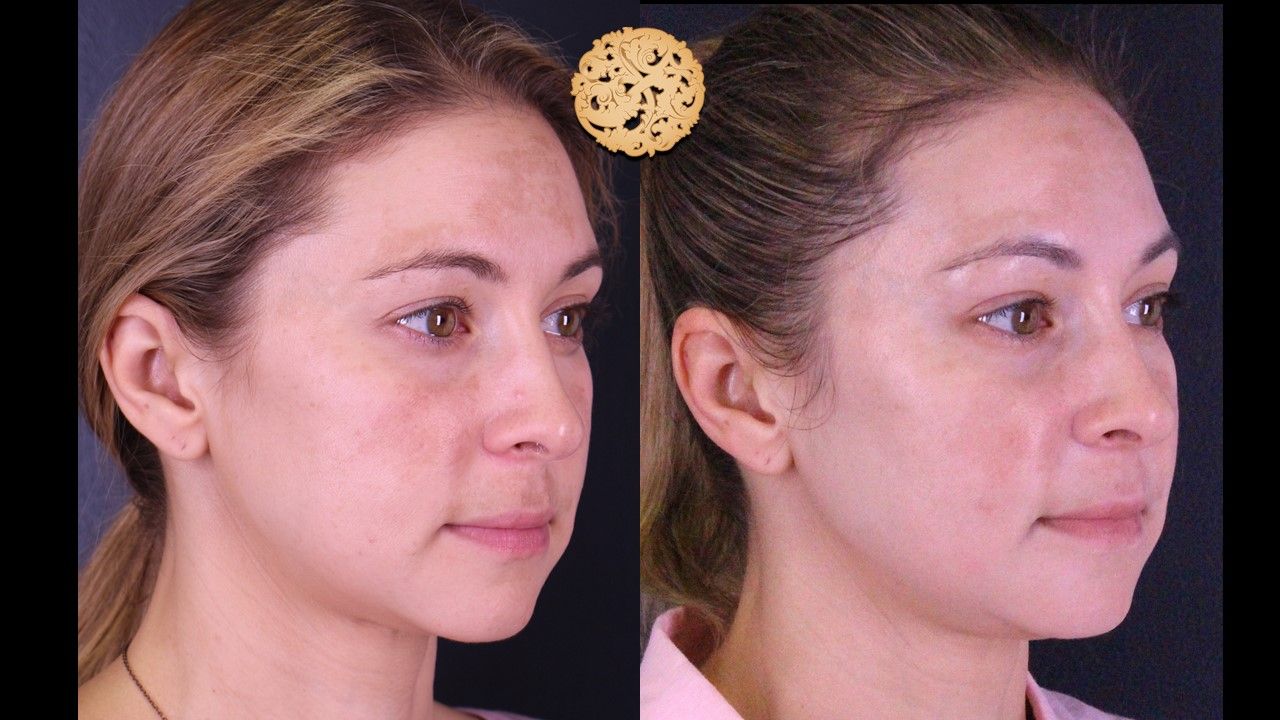 Chemical Peel Before & After