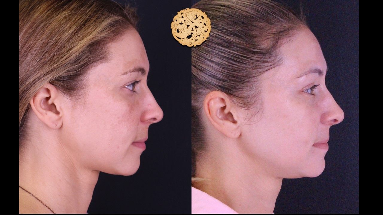 Chemical Peel Before & After