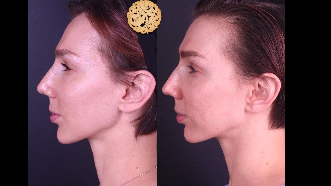 Chemical Peel Before & After