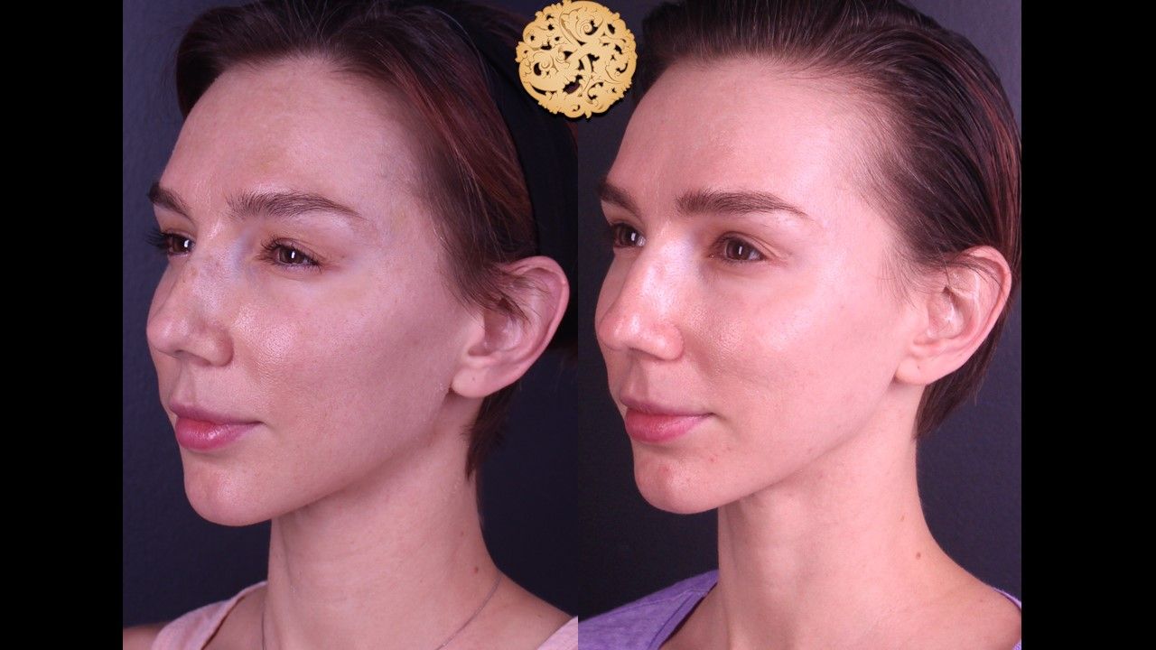 Chemical Peel Before & After