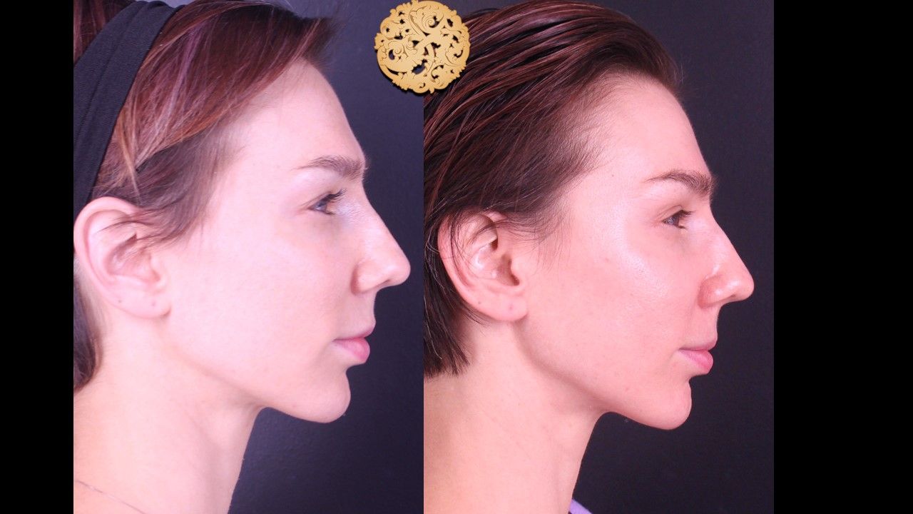 Chemical Peel Before & After