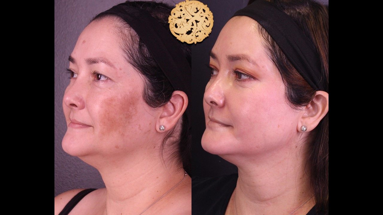 Chemical Peel Before & After