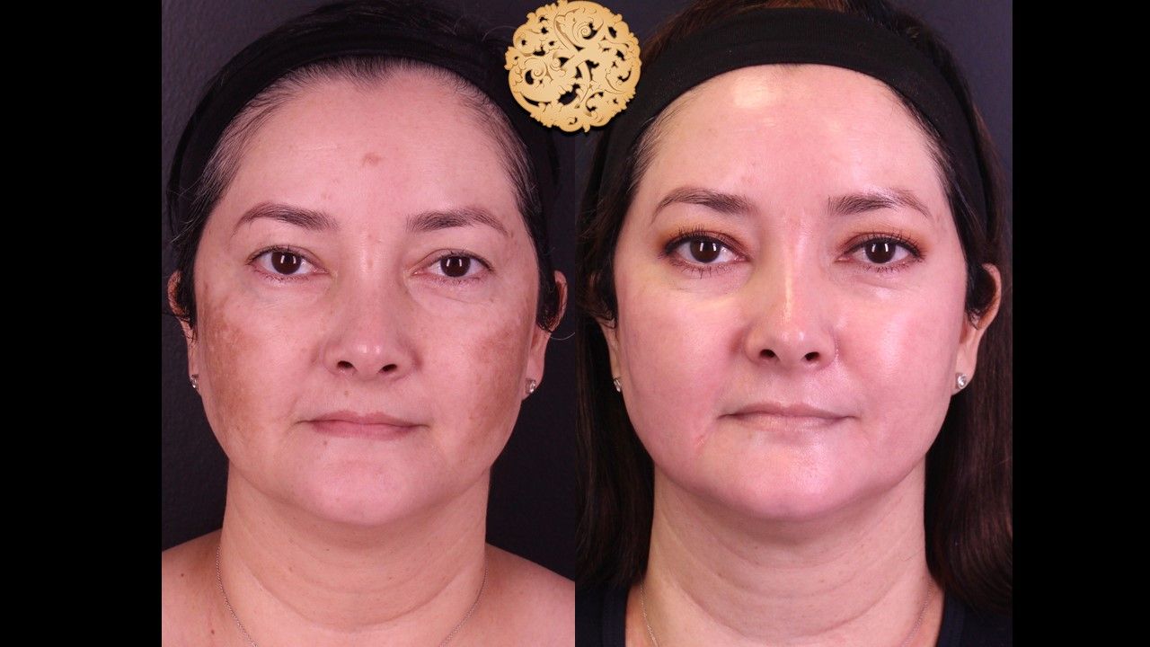 Chemical Peel Before & After