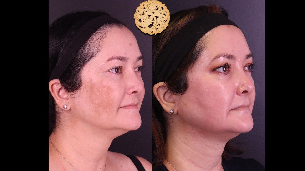 Chemical Peel Before & After