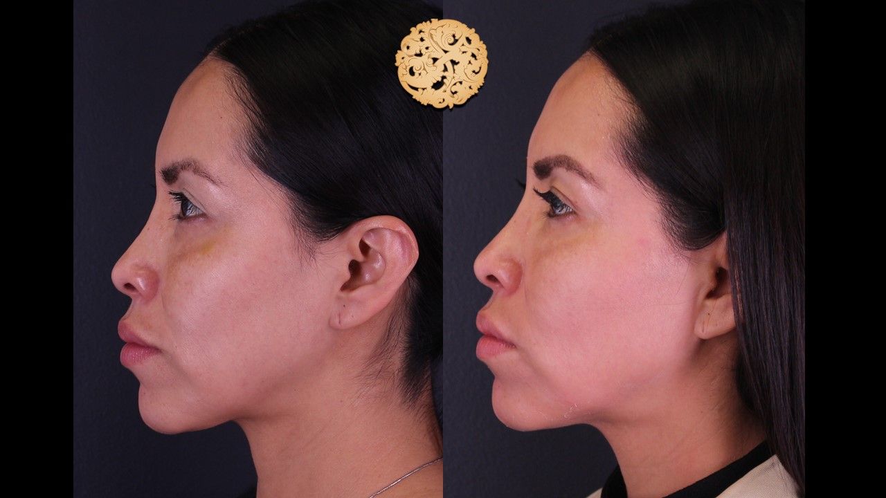 Chemical Peel Before & After