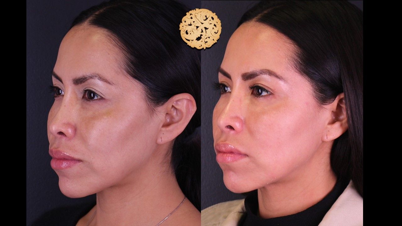 Chemical Peel Before & After