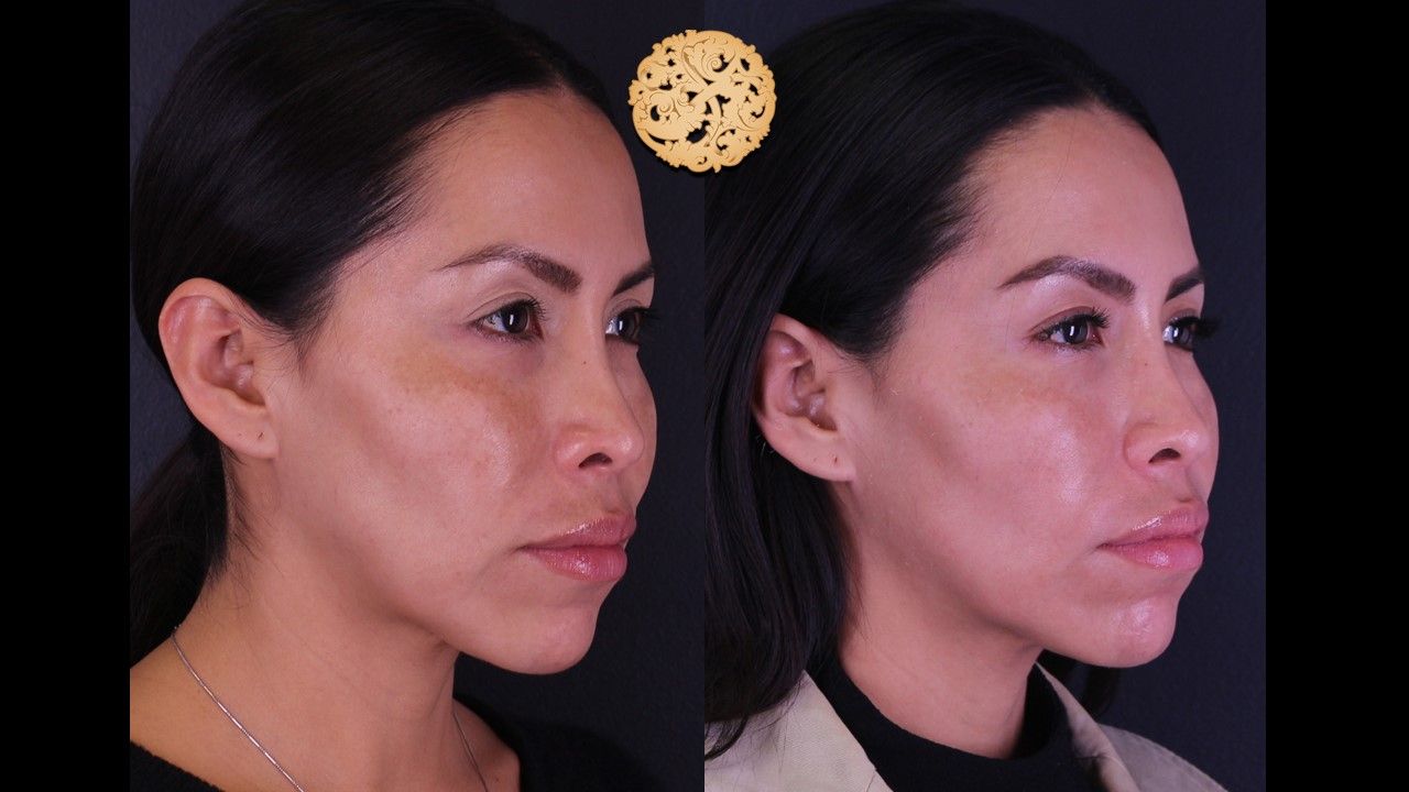 Chemical Peel Before & After