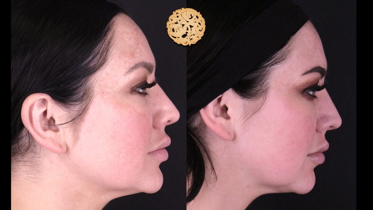 Chemical Peel Before & After