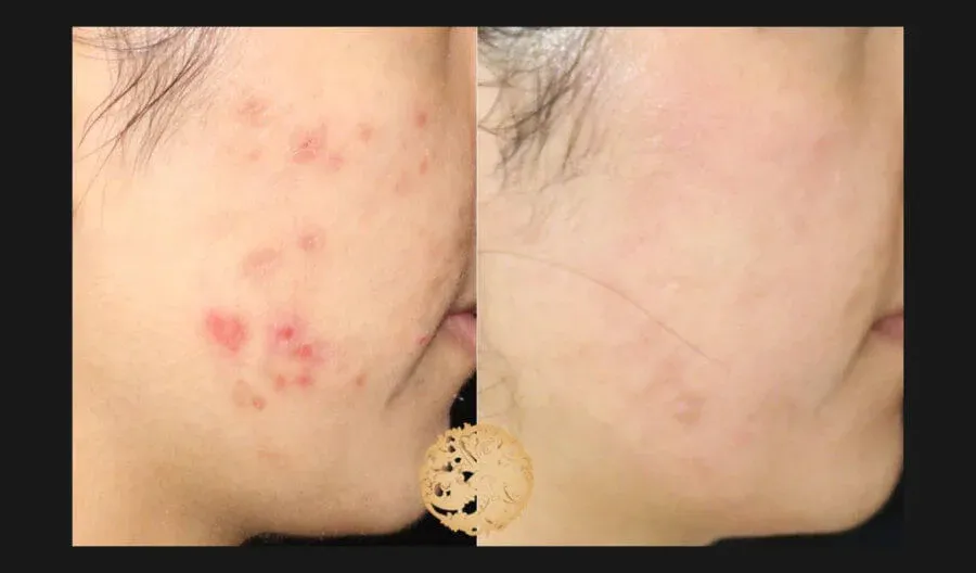 Chemical Peel Before & After