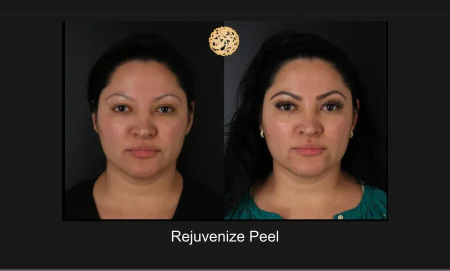 Chemical Peel Before & After