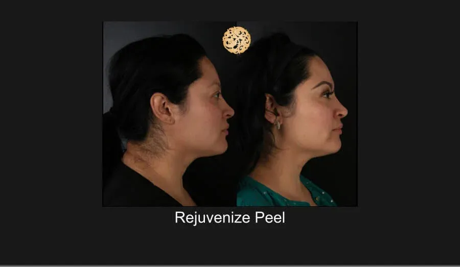 Chemical Peel Before & After