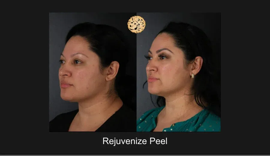 Chemical Peel Before & After