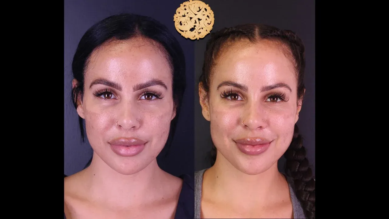 Chemical Peel Before & After