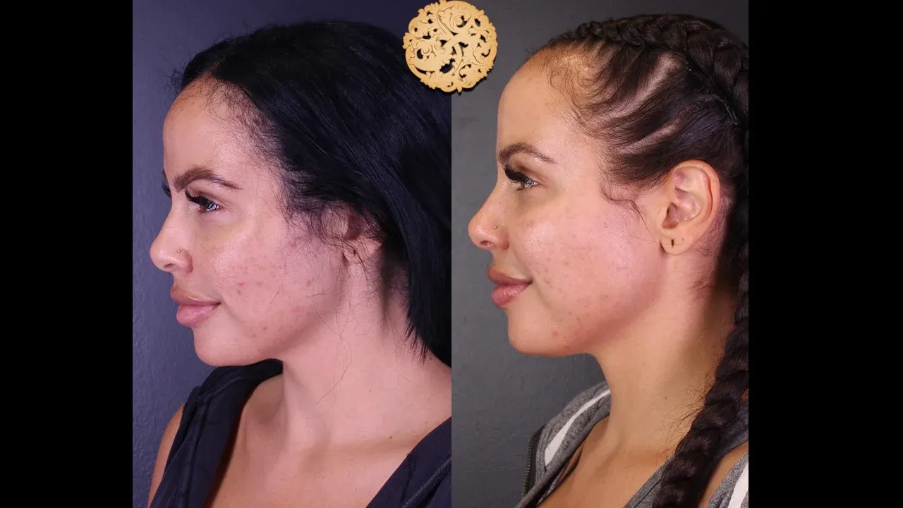 Chemical Peel Before & After