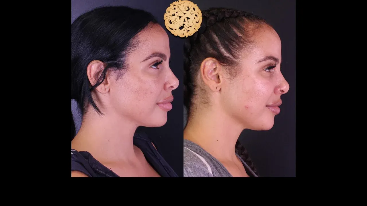 Chemical Peel Before & After