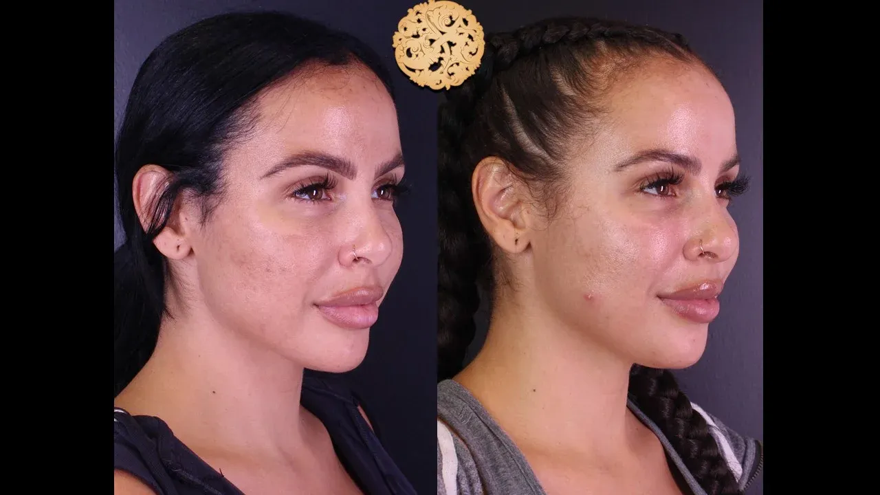 Chemical Peel Before & After