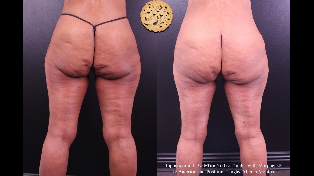 Morpheus Thighs Before & After
