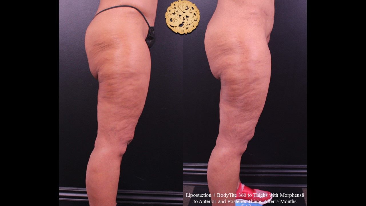 Morpheus Thighs Before & After