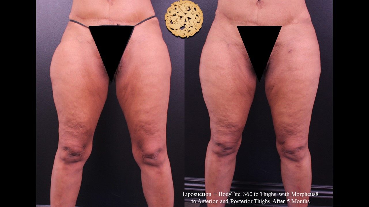 Morpheus Thighs Before & After