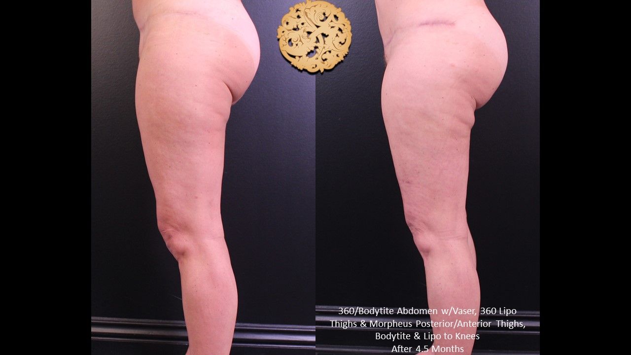 Morpheus Thighs Before & After