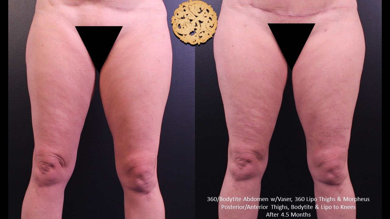 Morpheus Thighs Before & After