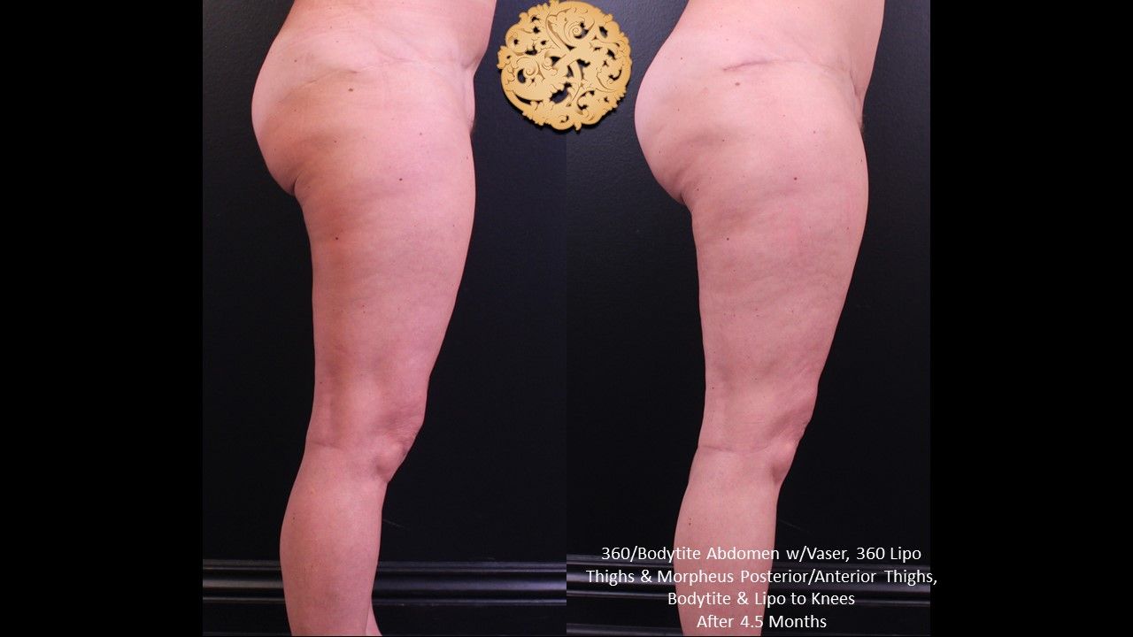 Morpheus Thighs Before & After