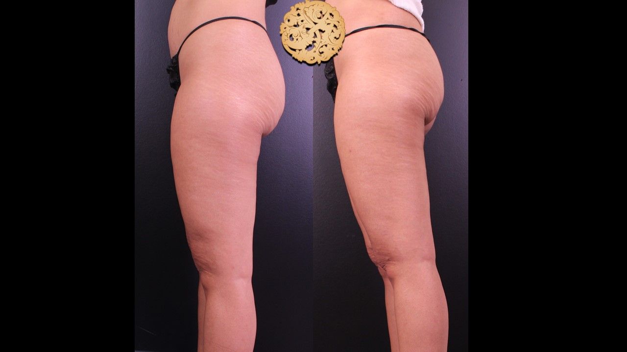 Morpheus Thighs Before & After