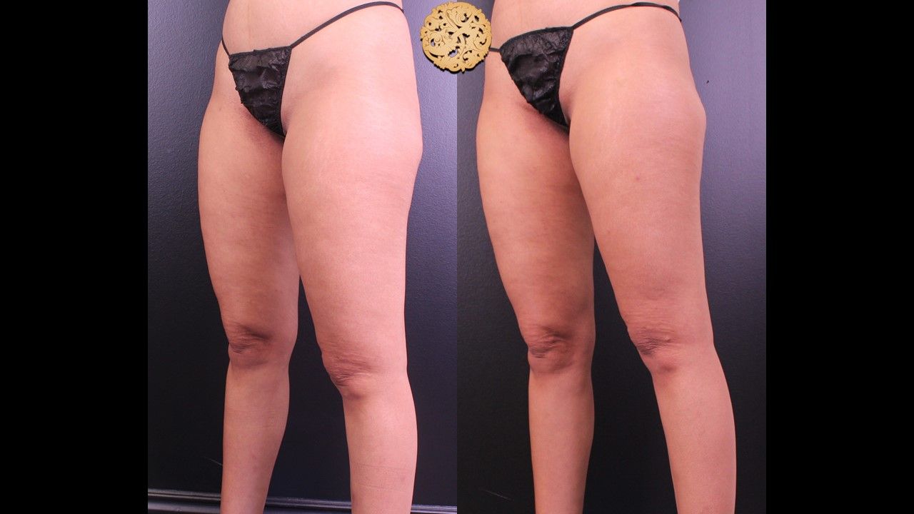 Morpheus Thighs Before & After