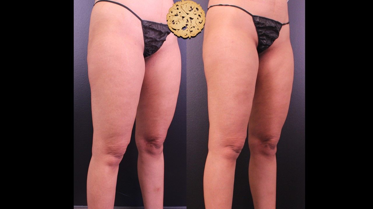 Morpheus Thighs Before & After