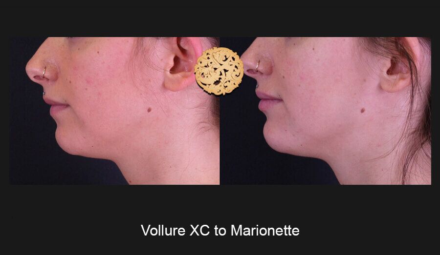 Marionette Filler Before & After